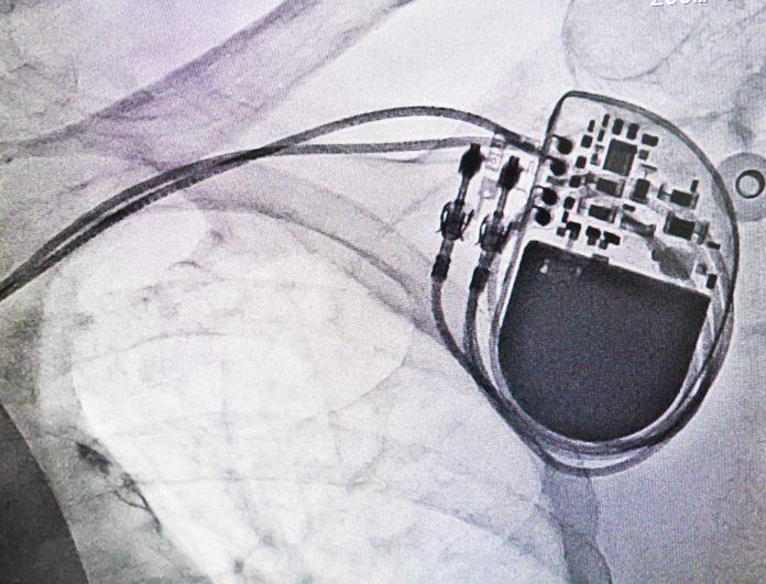 X-ray pacemaker pacemaker hack